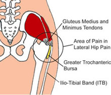 Lateral Hip Pain (Side)